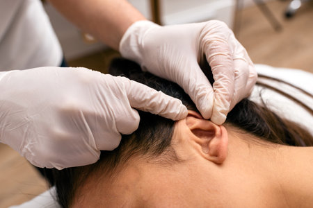 Stock photo of unrecognized worker doing acupuncture procedure to female client.の写真素材