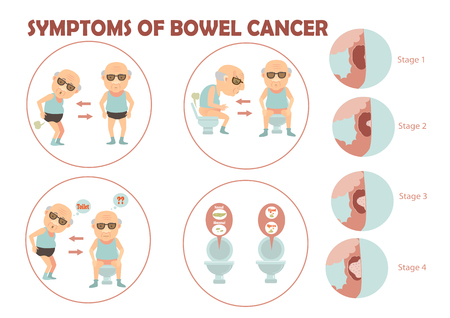 Old man suffered colon cancer and charts the growth of tumors in the colon infographic.Vector illustrationのイラスト素材