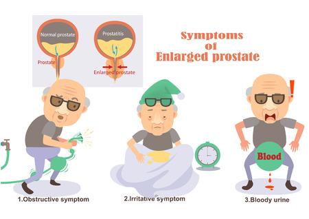 Symptoms of enlarged prostate Infographic.vector illustrationのイラスト素材