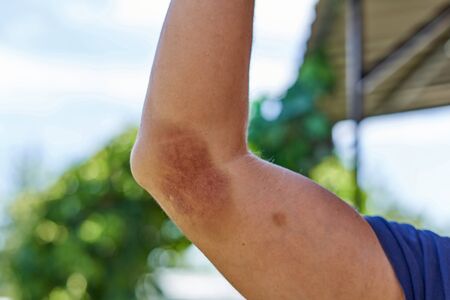 Injured limbs. Large bruise on the arm at the elbow. A strong hand injuryの写真素材