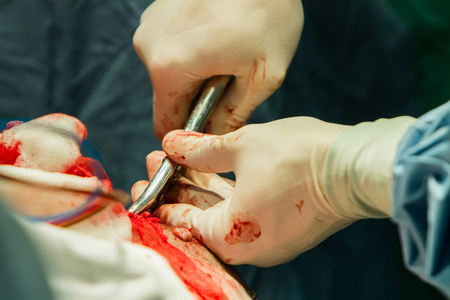 Close-up of a surgeon's hand with tongs breaking a skull bone.の写真素材