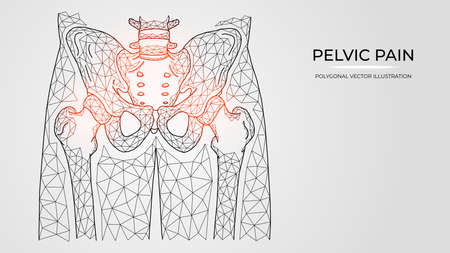 Polygonal vector illustration of pain, inflammation or injury in the pelvis and hip joint. Medical orthopedic diseases templatesのイラスト素材