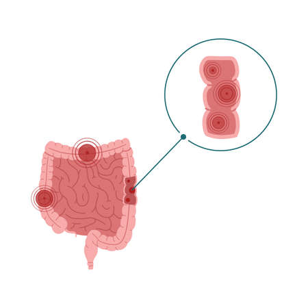 Inflammatory bowel disease vector illustration isolated on white backgroundのイラスト素材