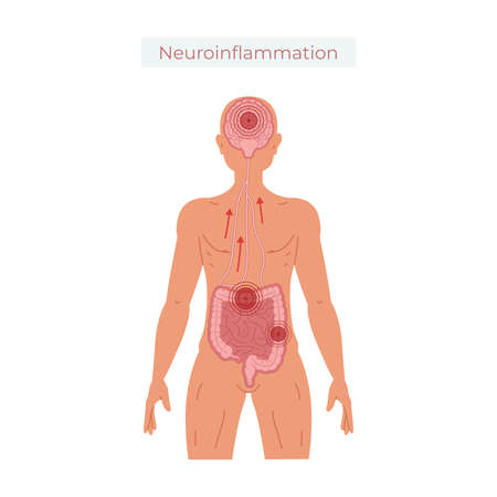 Poor gut health leads to neuroinflammation vector illustration.のイラスト素材