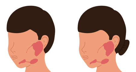 Localization of salivary glands in males and females. Medical vector illustration.のイラスト素材