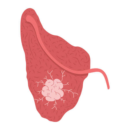 A tumor on the parotid salivary gland. Medical vector illustration.のイラスト素材