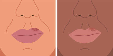 Vector illustration of herpes on the lip, cold sore, herpes simplex.のイラスト素材