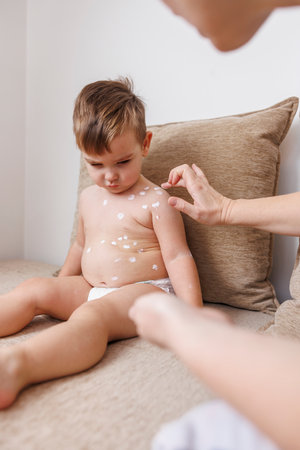 Mother taking care of son having Varicella or chickent pox, spreading ointment on blisters to prevent itching and scratchingの写真素材