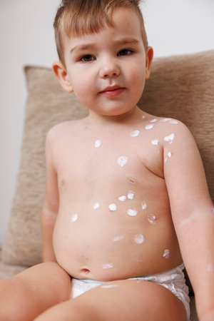Cute little toddler boy covered with smallpox blisters and rash treated with ointment for itching and scratching preventionの写真素材
