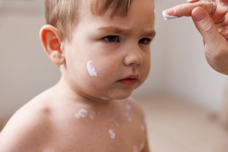 Mother spreading ointment on toddler boy's chickenpox blisters to prevent itching and scratchingの写真素材
