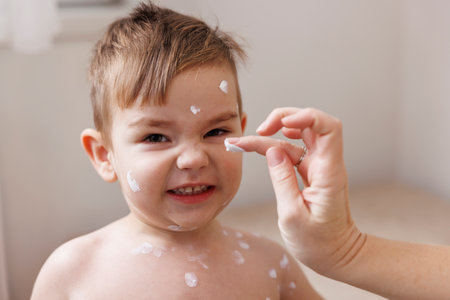 Mother spreading ointment on toddler boy's chickenpox spots to prevent itching and scratchingの写真素材