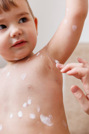 Mother spreading ointment on toddler boy's chickenpox spots to prevent itching and scratchingの写真素材