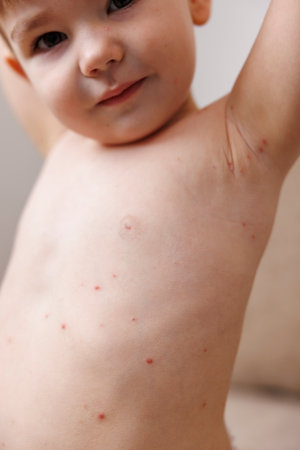Detail of toddler boy's skin covered with Varicella or chickenpox blisters and rashの写真素材