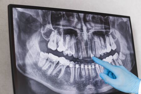 Doctor points to cured filled tooth in dental x-ray.の写真素材