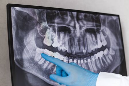 Doctor points wisdom tooth in dental x-ray.の写真素材