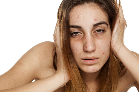 A girl with tired looks, problematic skin and dark circles around her eyes. Drugs addiction conceptの写真素材
