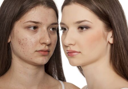 comarision portratit of teenage girl with problematic skin, before and after skin traitment on white backgroundの写真素材