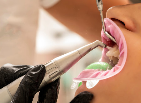 Closeup of teeth sandblasting, tartar cleaning and whitening
