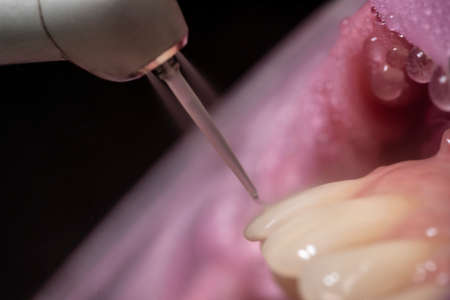 Closeup of laser etching teeth procedure for Direct Bonding of
Orthodontic Applianceの写真素材