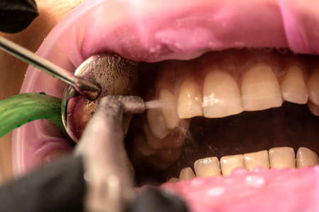 Closeup of teeth sandblasting, tartar cleaning and whiteningの写真素材