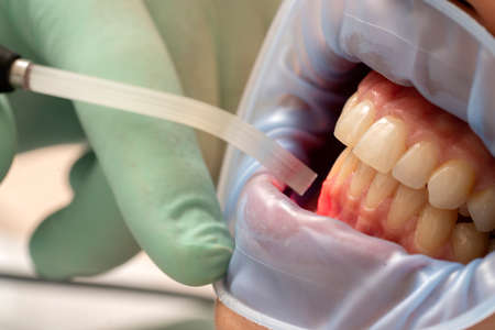 dental therapy with red LED light in the dental officeの写真素材