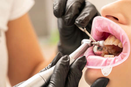 macro shoot of a dentist polishes his patient's teeth with a drillの写真素材