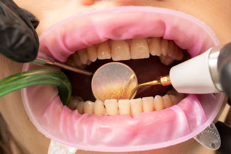 Closeup of dental calculus plaque remover toolの写真素材