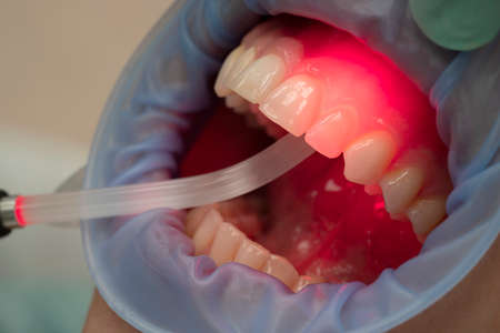 dental therapy with red LED light in the dental officeの写真素材