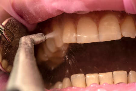 Closeup of teeth sandblasting, tartar cleaning and whiteningの写真素材