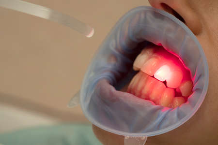dental therapy with red LED light in the dental officeの写真素材