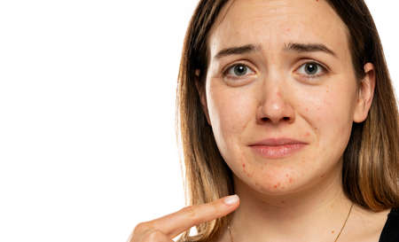 Young unhapy woman with the pimples on her face. Problematic skinの写真素材