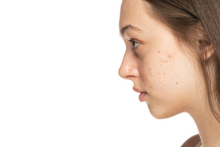 Profile of a beautiful young women with problematic skin.