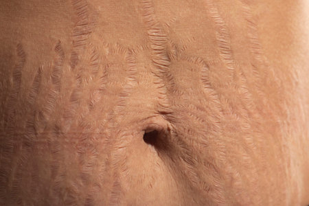 Close up human Skin natural stretch marks Texture background. Stretch mark woman belly.