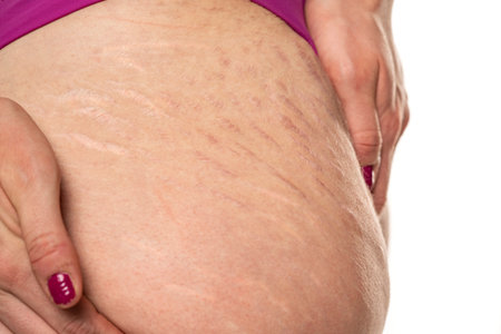 Close-up of a female thigh with white and dark stretch marks from a sharp weight loss or weight gain isolated on a white studio backgroundの写真素材