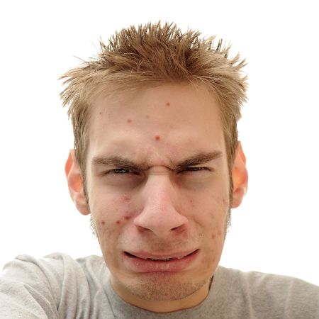 Teenage looks embarrassed and confused about the pimples that are showing up all over his face.の写真素材