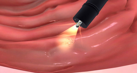 If abnormal-looking tissue is spotted during an upper endoscopy, a biopsy can be performed.3D renderingの写真素材