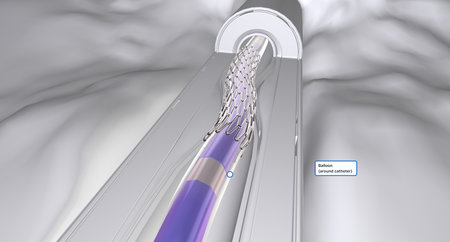 The catheter contains a specialized tip with a balloon and an expandable mesh tube, called a stent, that is collapsed around the balloon.3D renderingの写真素材