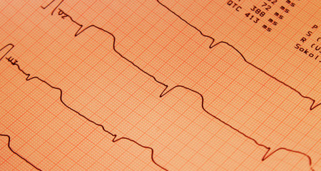 ecg