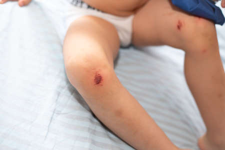 The legs of a five-year-old child with abrasions and wounds on the knees against the background of light-colored bedding.の写真素材