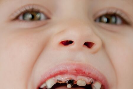 Close up of dentist's hands with assistant in blue gloves are treating teeth to a child, patient's face is closed.の写真素材