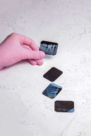 Doctor holding and looking at dental photo X-ray images on the x-ray film depicts the roots of the teeth of the chewing group are sealed after endodontic treatment.の写真素材