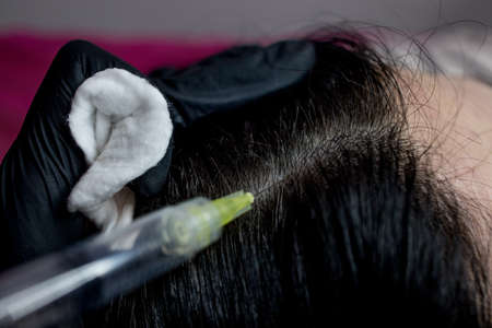 Needle mesotherapy. cosmetologist makes injections in woman head. strengthen the hair and their growth.の写真素材