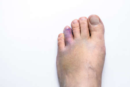 Injured foot with broken toe on white backgroundの写真素材