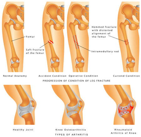 Fractures of Femur  Hemmed fracture with distorted alignment of the femur  Fixation of Femur Fracture with Placement of Intramedullary Rod  Types of Arthritis - Osteoarthritis, Rheumatoid Arthritisのイラスト素材