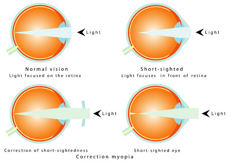 Myopia  Normal vision, light focused on the retina  Short - sighted, light focused in front of retina, so the eye interprets a blurred image  Correction of myopia  Correction of short - sightednessのイラスト素材
