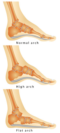 Arch of Foot  Set of flat foot, high arch  Rheumatoid Arthritis In Arch Of Foot  Various stages of the disease on white backgroundのイラスト素材