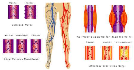 Vascular System Legs  Atherosclerosis in artery  Deep venous thrombosis  Varicose Veins  Calf muscle...