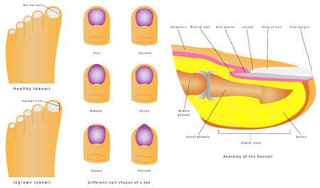 Anatomy of the Toenail. Different shapes of the Toenail. Healthy and Ingrown toenails over white backgroundのイラスト素材