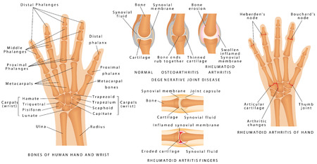 Skeletal System Phalanges. Human hand bones anatomy. Skeleton of the hand. Degenerative joint disease. Bones of human hand and wrist. Rheumatoid Arthritis Fingers.のイラスト素材