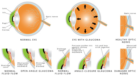 Glaucoma is an eye disease and a leading cause of blindness. Open - angle glaucoma. Angle - closure glaucoma. The optic nerve is injured. The intra-ocular pressure is increased. Stages of glaucomaのイラスト素材